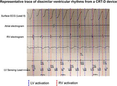 Interventricular Differences in Action Potential Duration Restitution Contribute to Dissimilar Ventricular Rhythms in ex vivo Perfused Hearts